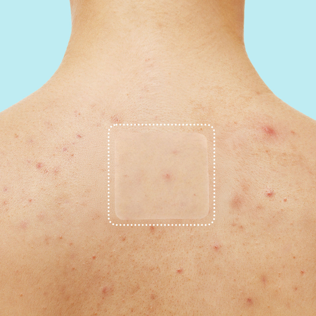 Miracle Patch XL Spot Control Cover X0