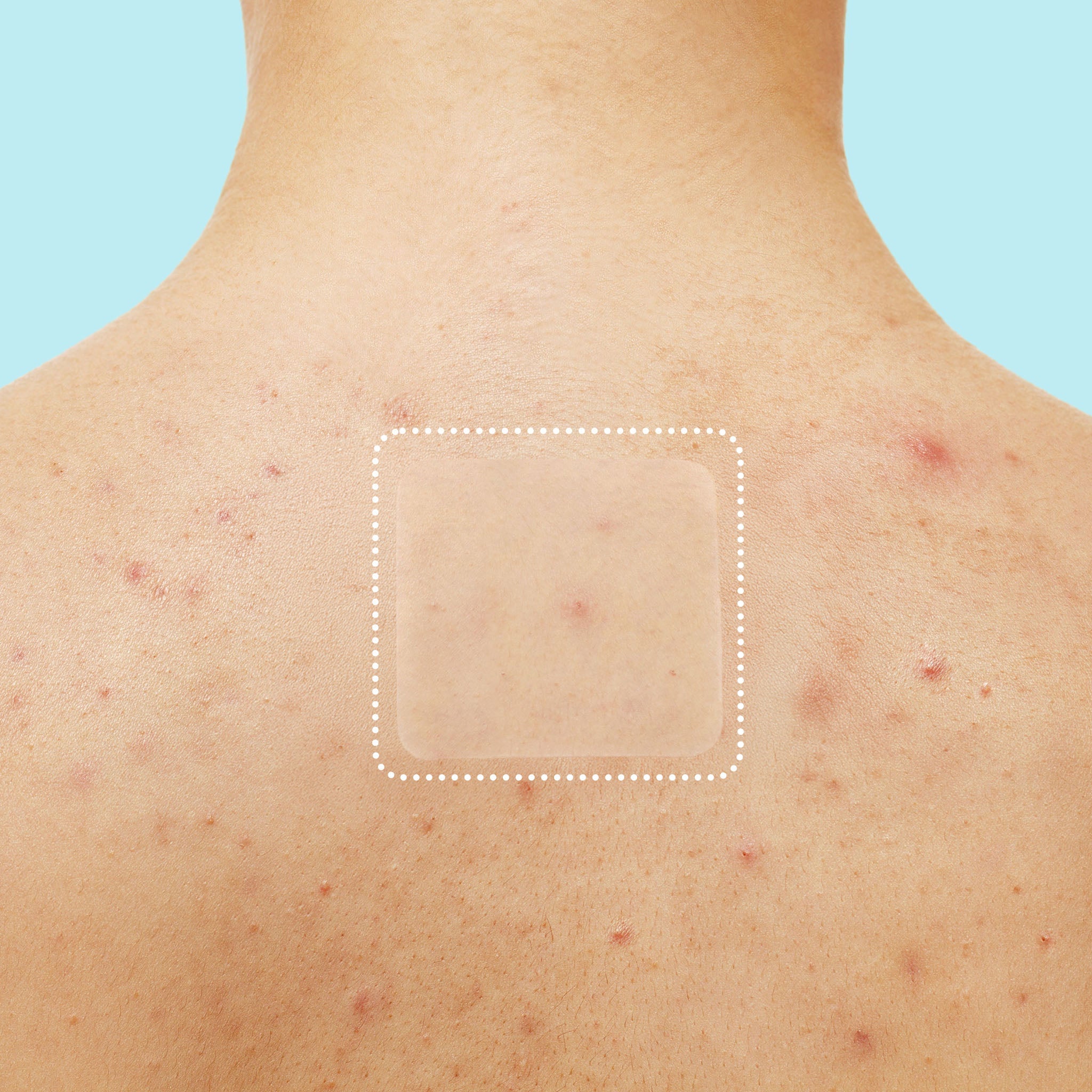 Miracle Patch XL Spot Control Cover X0