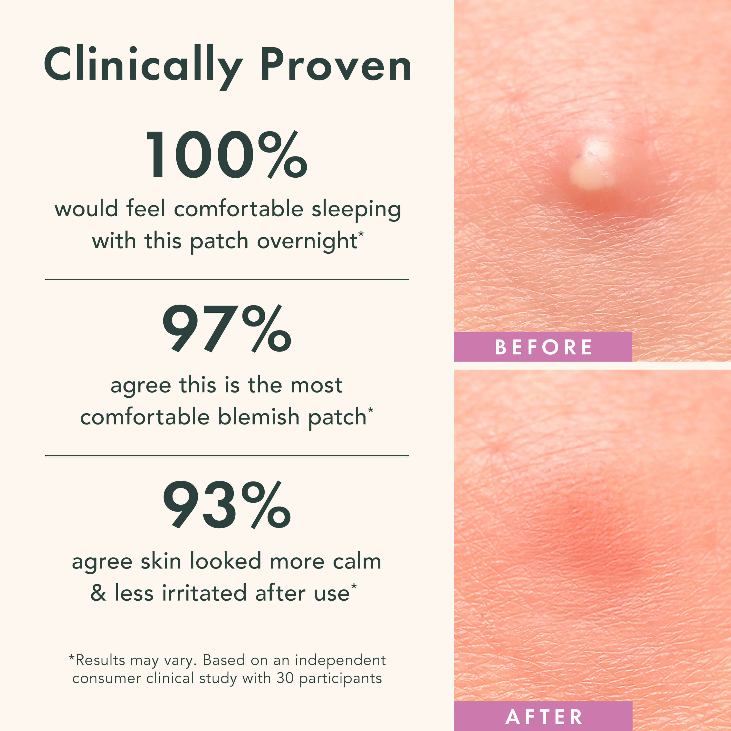 Miracle Patch Overnight Spot Cover Z9